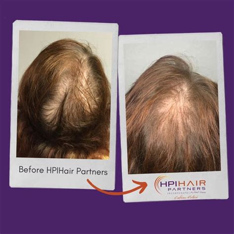 Telogen Effluvium | HPI Hair Partners Nashville