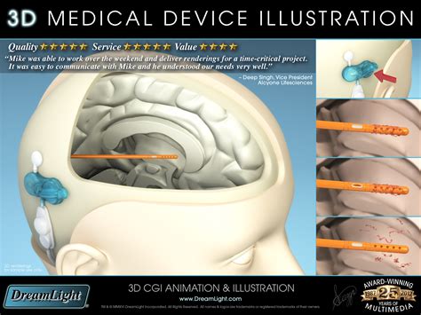 3D Medical Device Illustration - Cerebral Shunt - DreamLight.com ...