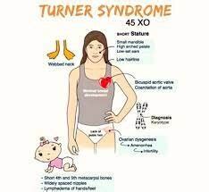 turner syndrome causes Archives - Samarpan Physiotherapy Clinic