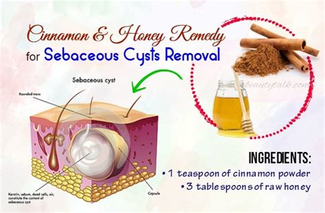 15 Remedies On How To Get Rid Of Sebaceous Cysts Naturally