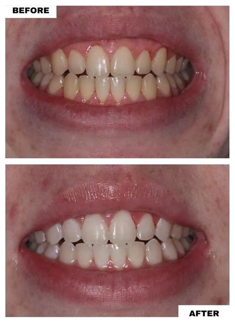 Cosmetic Dentistry Before and After: Invisalign, Zoom, Veneers - South ...