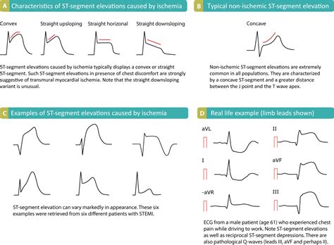 STEMI (ST Elevation Myocardial Infarction): diagnosis, criteria, ECG & management – ECG & ECHO