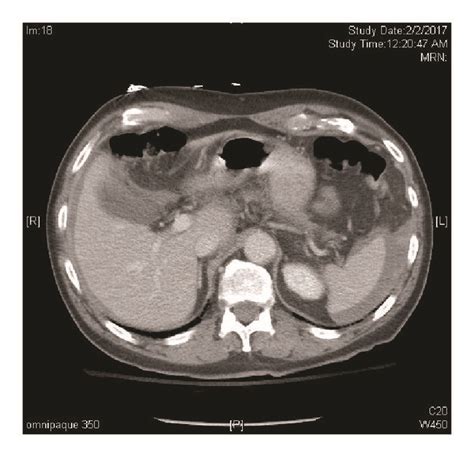 Horizontal CT scan demonstrating hemoperitoneum from iatrogenic spleen... | Download Scientific ...