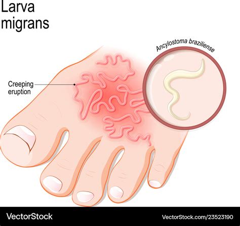 Cutaneous larva migrans skin disease in humans Vector Image