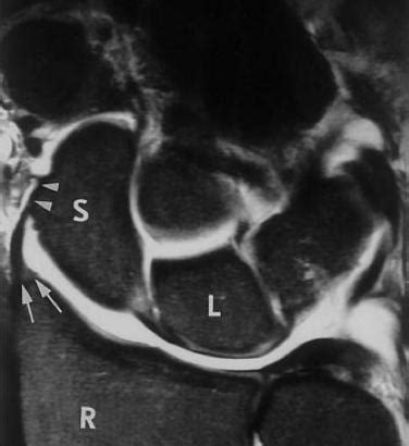 Ulnar Collateral Ligament Wrist Mri