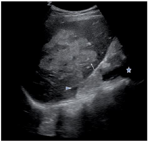 Figure 1 from FAST identification of traumatic liver laceration | Semantic Scholar