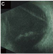 Globe rupture after keratoplasty