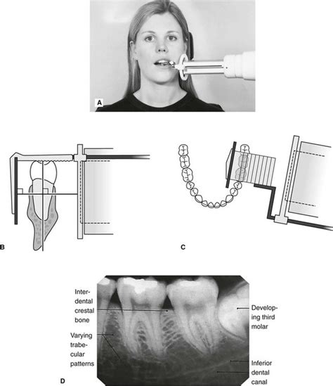 Periapical X Ray