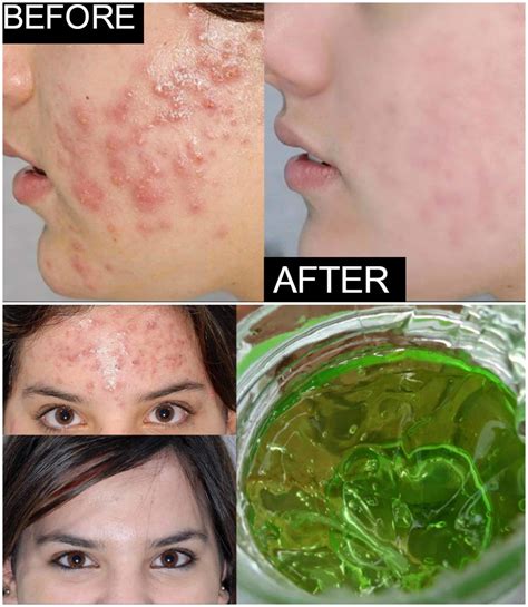 Effective Homemade Aloe Vera Acne Remedies That Will Do Wonders For ...