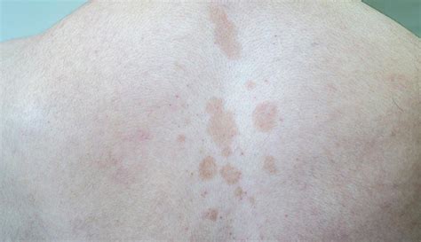 Tinea Versicolor: Symptoms, Causes & Treatments