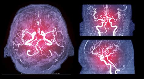 Gadolinium Contrast Agents Side Effects | Richard Harris Law