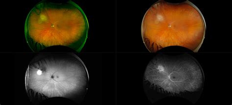 Choroidal Nevus