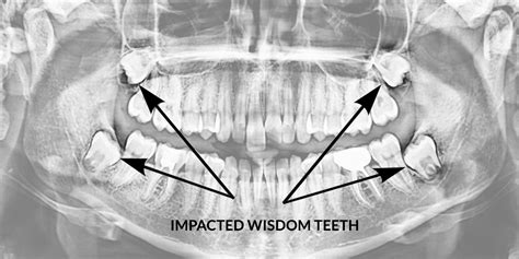 Wisdom Teeth | Oral Surgery Procedures