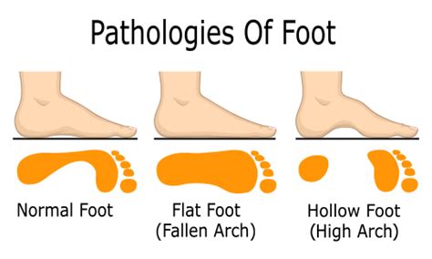 Types Of Foot Arches