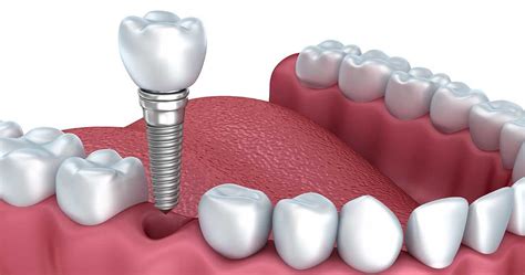 Sdn 2024 Dental Implants - Mela Stormi