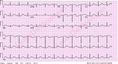 Hypocalcemia ECG Example | LearntheHeart.com