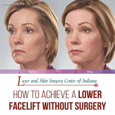 Achieve a Lower Facelift Without Surgery - The Laser and Skin Surgery Center of Indiana