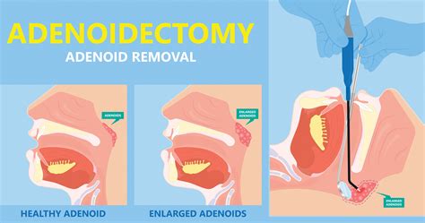 Adenoid Surgery - Evren Aykoç | Kulak Burun Boğaz Uzmanı