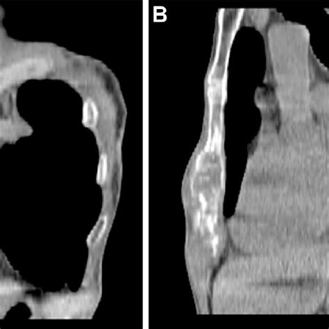 (PDF) Colon cancer metastasis to the sternum: palliative treatment with radiofrequency ablation ...