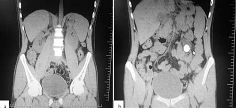 What Is A Ct Scan With Contrast Like