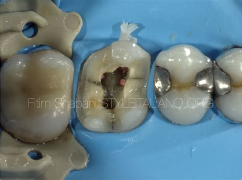 Treatment of a cracked tooth - Style Italiano Endodontics