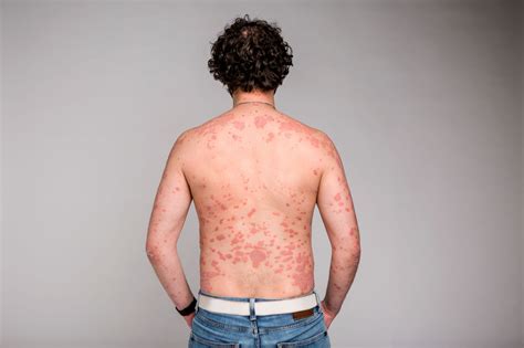 About Psoriasis - Psoriasis Cure Now