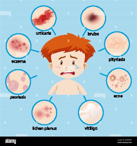 Skin conditions children Stock Vector Images - Alamy