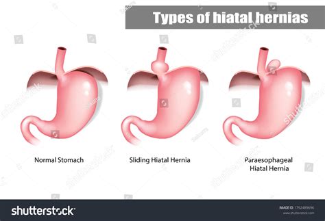 Esophagus Hernia