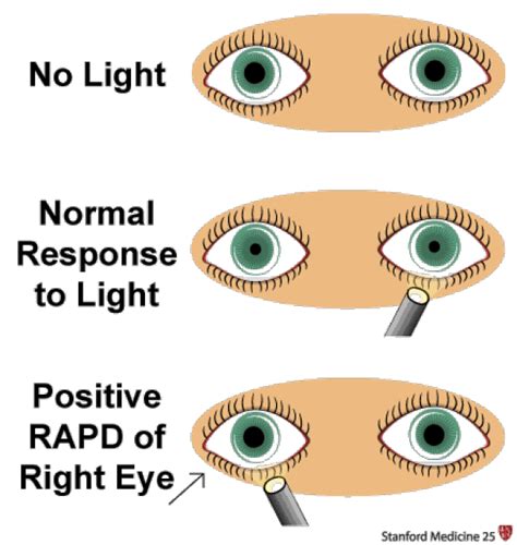 Corneal Light Reflex Abnormal Findings