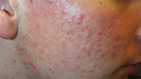 Skin Disorders: Pictures, Causes, Symptoms, Treatments, and Prevention