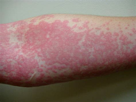 Allergy to Mold - Symptoms, Mold Allergy Rash, Test & Treatment