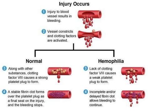 Haemophilia: Royal disease