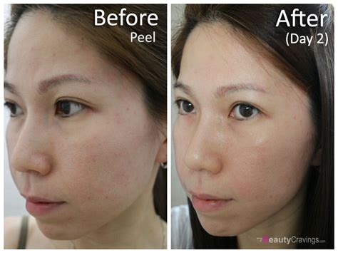 Review: At-Home 40% Glycolic Acid Peel from MUAC (Part 2 ...