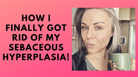 Finally getting rid of my Sebaceous Hyperplasia - Collab with PennSmithSkincare! - YouTube