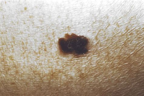 Skin Cancer Symptoms: How to Check for Moles | Reader’s Digest