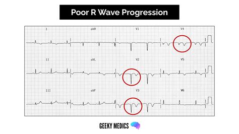 High s waves ecg causes - perkslimfa