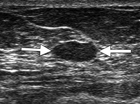 Breast Applications - Sam's Ultrasound Program