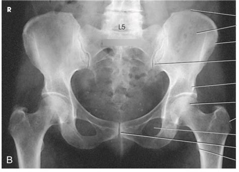 AP Pelvis X-Ray Anatomy Diagram | Quizlet