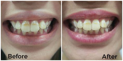 iWhite Instant Teeth Whitening Kit review: See before and after photos!