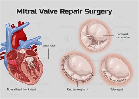 Mitral Valve Prolapse Replacement Surgery In Hyderabad | Dr.Sudheer