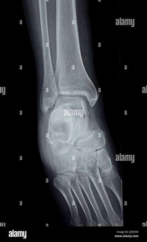 An X-rays of the human foot, bones, clinic, xray Stock Photo - Alamy