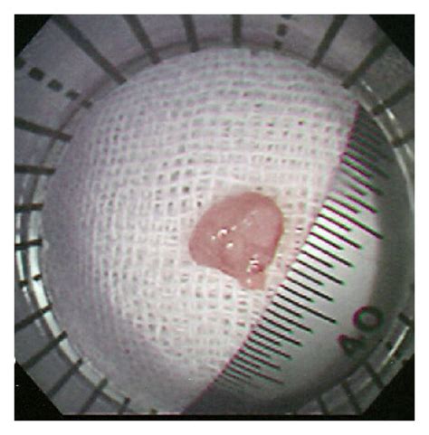 (a) A sessile polyp with a diameter of 6 mm was measured using the side... | Download Scientific ...