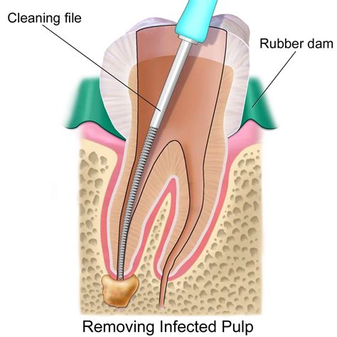 Root Canal Therapy – Australian Dental Specialists