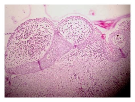 Histological view of radicular cyst. | Download Scientific Diagram