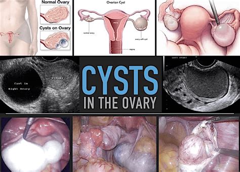 Ovarian Cyst Clinic in Singapore | Dr Anthony Siow