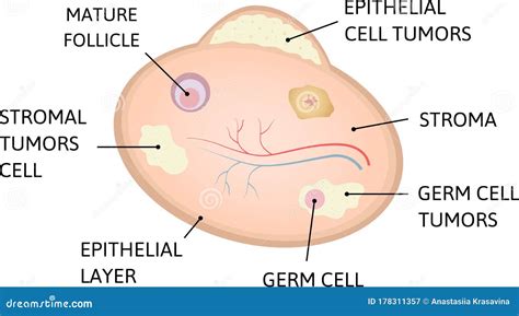 Ovarian Cancer. Cancer of Epithelial Layer, Germ Cell, Stromal Tumors Cell Stock Illustration ...