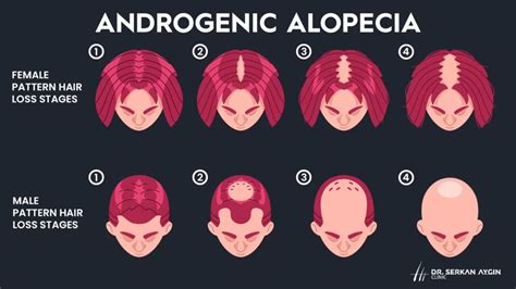 Androgenic Alopecia: Causes, Symptoms & Effective Treatments - Dr Serkan Aygin Clinic