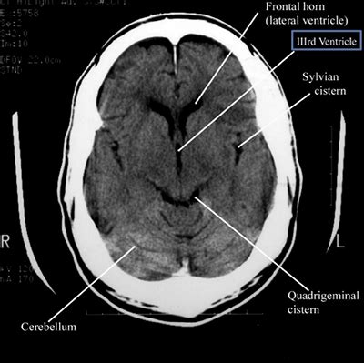 How to read a head CT - Emergency Medicine Education | NewYork-Presbyterian