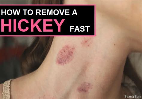 Top 10 Easy Ways to Get Rid of a Hickey Overnight