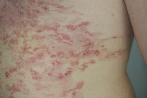 Extensive Cutaneous Larva Migrans in: The American Journal of Tropical Medicine and Hygiene ...